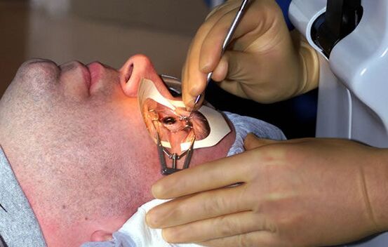 Scleroplasty to treat myopia and stabilize vision