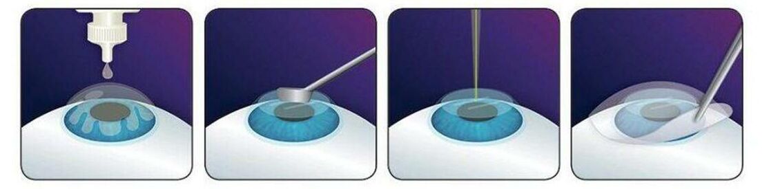 Laser Vision Correction Using Photorefractive Keratectomy