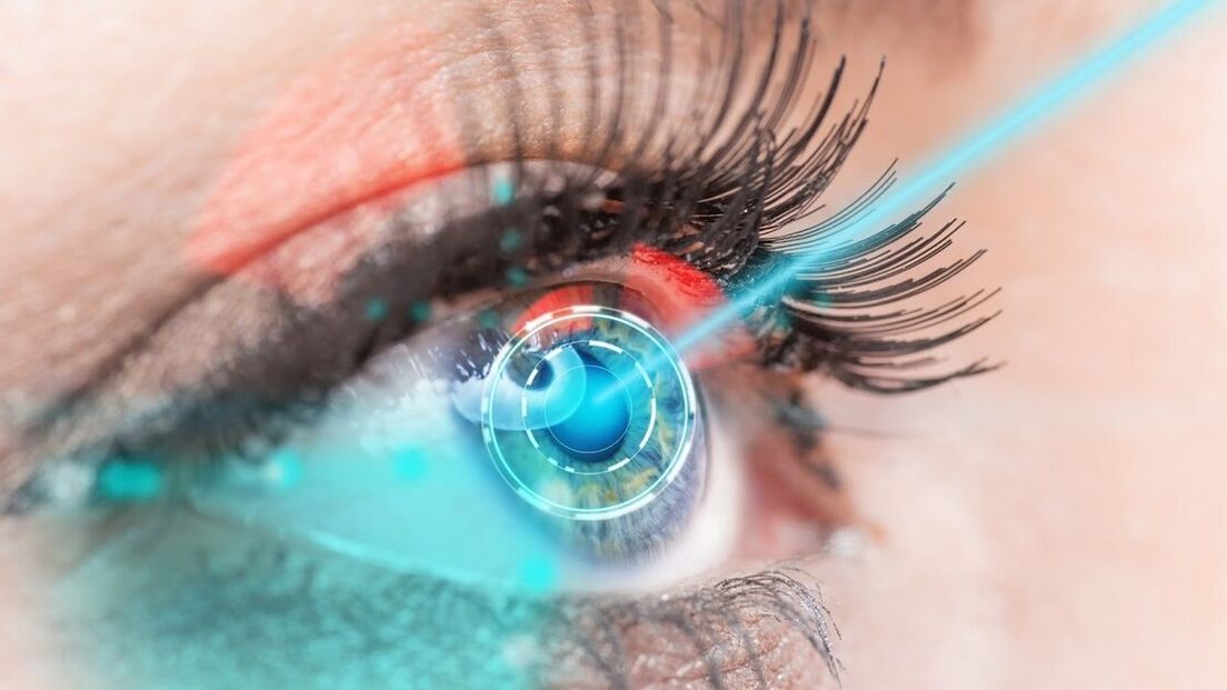 Restoring vision with laser correction